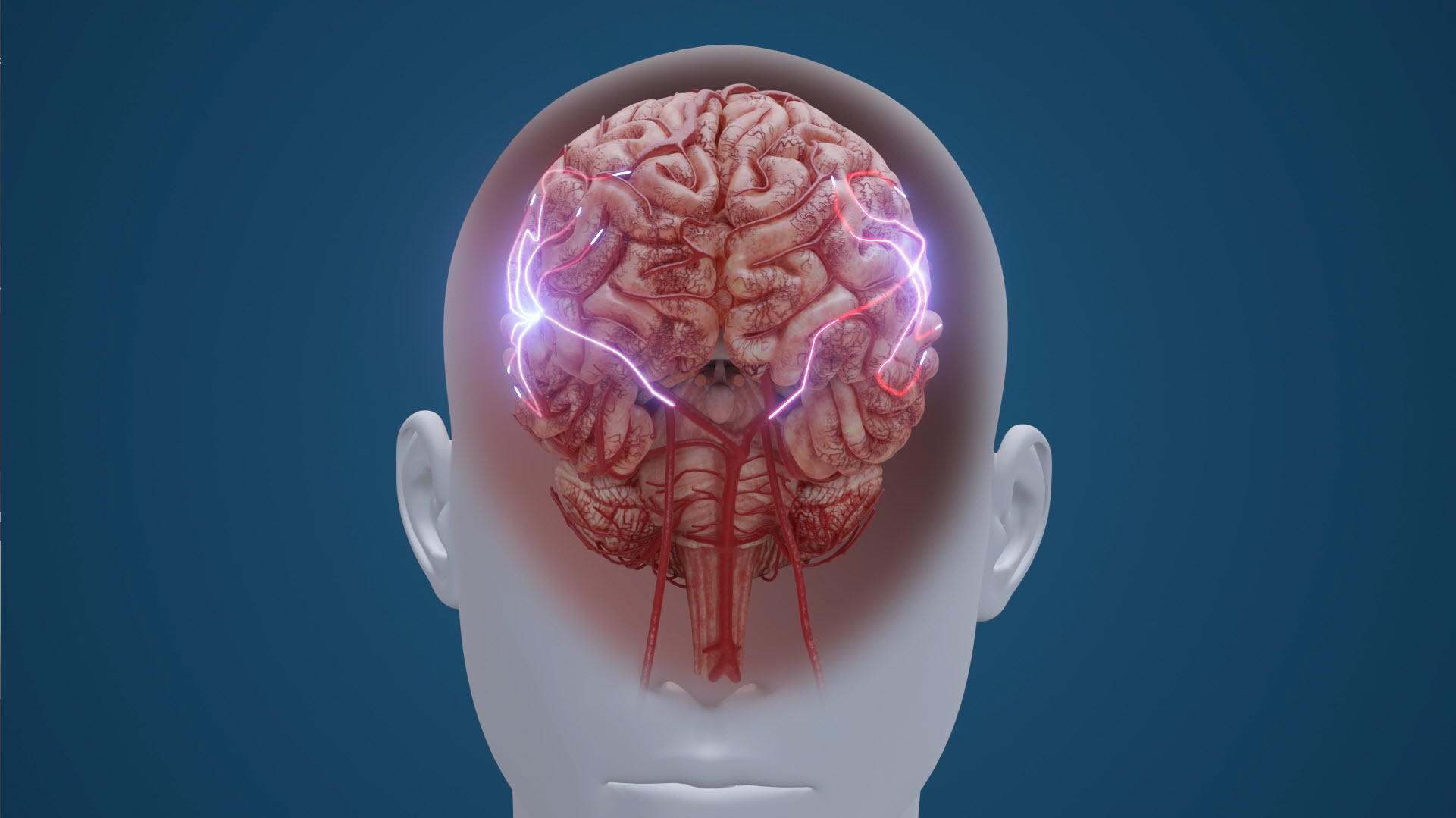 Sectioned brain inside a head with the affected tissue highlighted